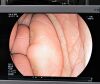 FUJINON ED580XT Duodenoscope