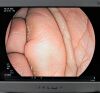 FUJINON ED580XT Duodenoscope