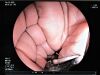FUJINON EG530UT2 Gastroscope
