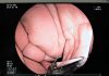 FUJINON EG530UT2 Gastroscope