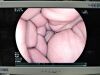 FUJINON EC-530HL2 Colonoscope