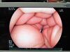FUJINON EC-530HL Colonoscope