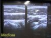 PHILIPS L12-3 Linear Array Ultrasound Transducer