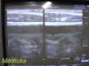 PHILIPS L12-3 Linear Array Ultrasound Transducer