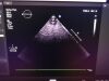 PHILIPS X5-1 Ultrasound Transducer