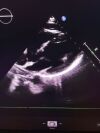 PHILIPS X5-1 Ultrasound Transducer