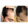 HAIRSMART 272 Laser Cap