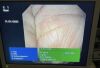 OLYMPUS TJF-160R Duodenoscope