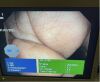 OLYMPUS BF-Q180 Bronchoscope