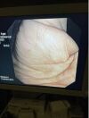 OLYMPUS TJF-140R Duodenoscope