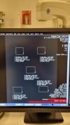 SIEMENS 10501286 Anrad LMAM1 Detector Mammo Unit