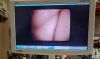 PENTAX EPK 1000 and VLS-1070STK Video Processor and Laryngostroboscope