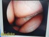STRYKER 502-427-030 Rigid Telescope, 4mm x 30°, Video Endoscope
