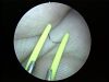GME NEW STORZ COMPATIBLE RESECTOSCOPE SET - MADE IN GERMANY Cystoscope