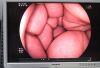 FUJINON ES-450WE5 Sigmoidoscope