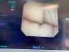 KARL STORZ 11278 VUA Flex-XC Videoscope Ureteroscope perfect CCD WARRANTY Ureteroscope