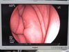 FUJINON ED-530XT Duodenoscope