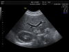 GE AB2-7-D Ultrasound Transducer