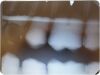KODAK Carestream RVG 6100 Size 2 Digital Dental X-Ray Sensor