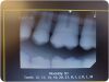 KODAK Carestream RVG 6100 Size 2 Digital Dental X-Ray Sensor