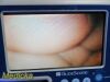 VERATHON Glidescope Portable GVL Monitor