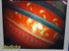 SMITH & NEPHEW DYONICS 30° x 4mm Rigid Telescope Video Arthroscope