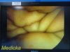 SMITH & NEPHEW 7208130 DYONICS 10mm x 0° Rigid Laparoscope