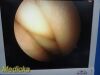 SMITH & NEPHEW 4126 DYONICS 4mm x 70° Video Arthroscope Rigid Telescope