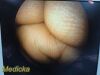 SMITH & NEPHEW 4126 DYONICS 4mm x 70° Video Arthroscope Rigid Telescope