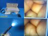 OLYMPUS Circon ACMI LAP 11-56W Laparoscopic Tubal Ligation Set W/ Case