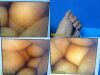 OLYMPUS Circon ACMI LAP 11-56W Laparoscopic Tubal Ligation Set W/ Case