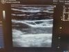 GE 8L-RS Ultrasound Transducer