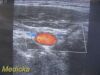 SIEMENS 2008  VFX9-4 Ref 05936237 Linear Array Ultrasound Probe /