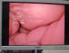 OLYMPUS A50003A Laparoscope