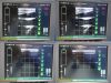 BARD Chison Med SiteRite VI 9770066 Sherlock 3CG Vascular Access Sys W/ Probe