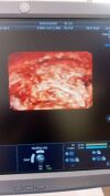 GE RIC5-9-D probe Ultrasound Transducer