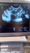 GE RIC5-9-D probe Ultrasound Transducer