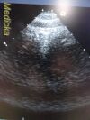 ACUSON 7V3C Model 08260630 Phased Array Ultrasound Transducer