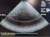 ACUSON 7V3C Model 08260630 Phased Array Ultrasound Transducer