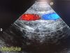 ACUSON 7V3C Model 08260630 Phased Array Ultrasound Transducer