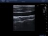 TOSHIBA PLT704SBT Ultrasound Transducer