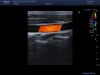 TOSHIBA PLT704SBT Ultrasound Transducer