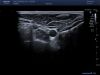 TOSHIBA PLT1005BT Ultrasound Transducer