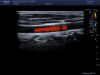TOSHIBA PLT1005BT Ultrasound Transducer