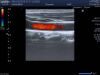 TOSHIBA PLT-1204BX Ultrasound Transducer