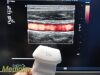PHILIPS L17-5, Frequency 5.0 – 17.0MHz~  Linear Array Ultrasound Transducer