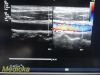 PHILIPS L9-3 Linear Array Ultrasound Transducer