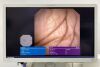 OLYMPUS CHF-V  Uses: 60 Endoscope
