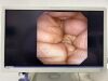 OLYMPUS CHF-V  Uses: 60 Endoscope