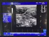 GE Logiq E Ultrasound System (2009 )With Probe 8L-RS DR
